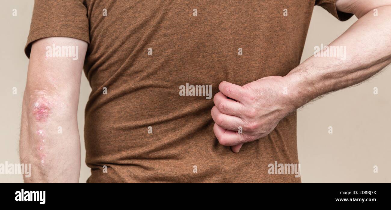Back psoriasis. Man hands scratching the itch on the back. Concept of