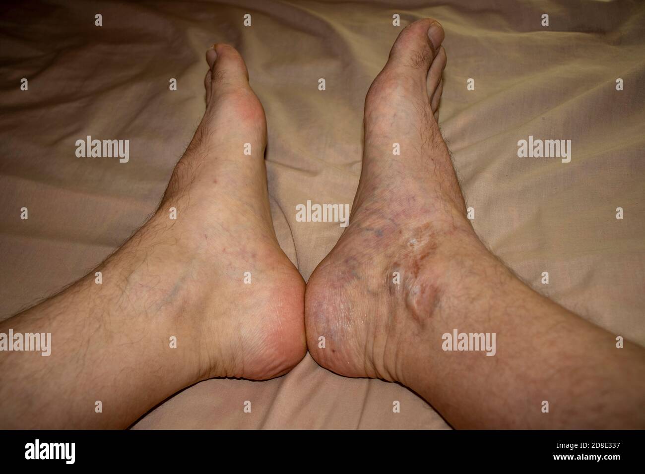 Damaged right foot of a 40 years old male which was severely damaged in car  accident and healed over a years in comparison with normal left foot. Clos  Stock Photo - Alamy