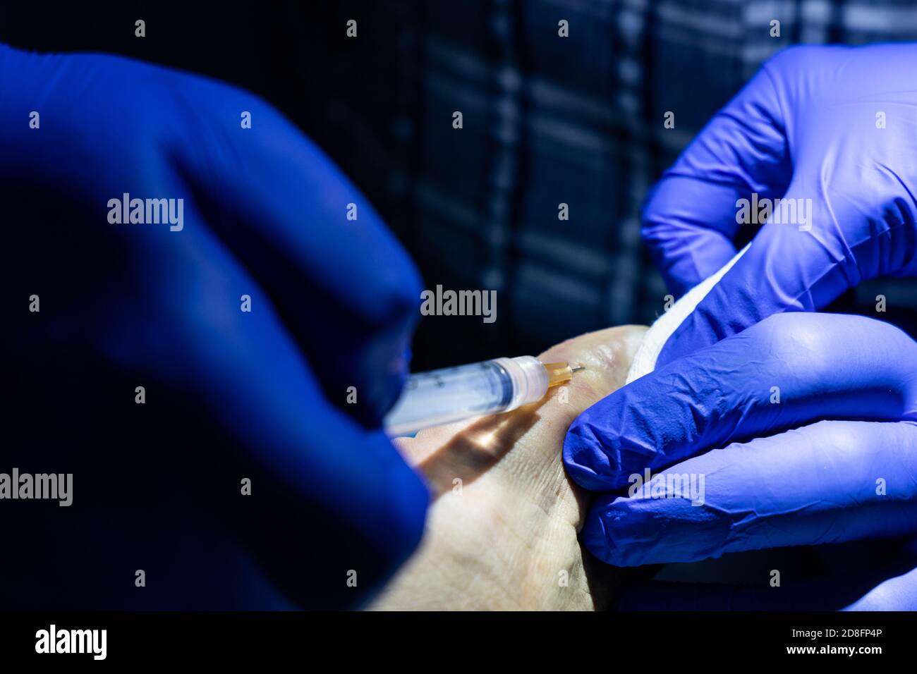 Series of ingrown toenail treatment. Medical doctor injecting local