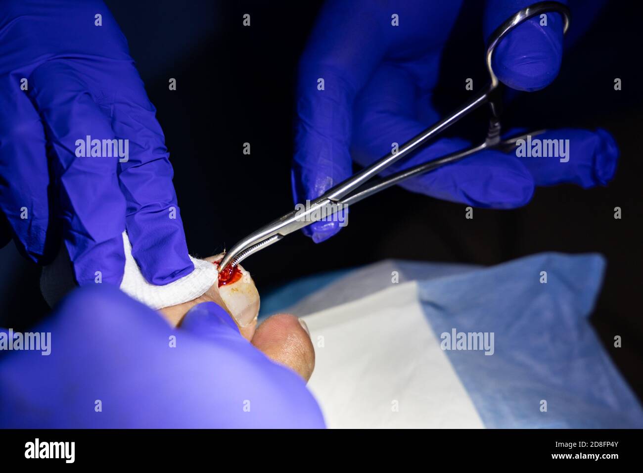 Series of ingrown toenail treatment. Medical doctor cut and extract