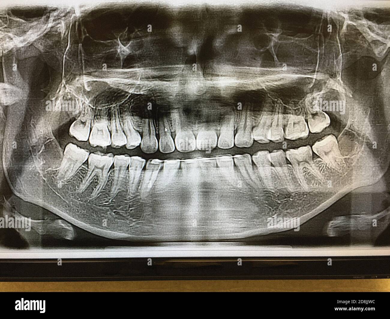 Dental X-Ray of Teen Girl Stock Photo