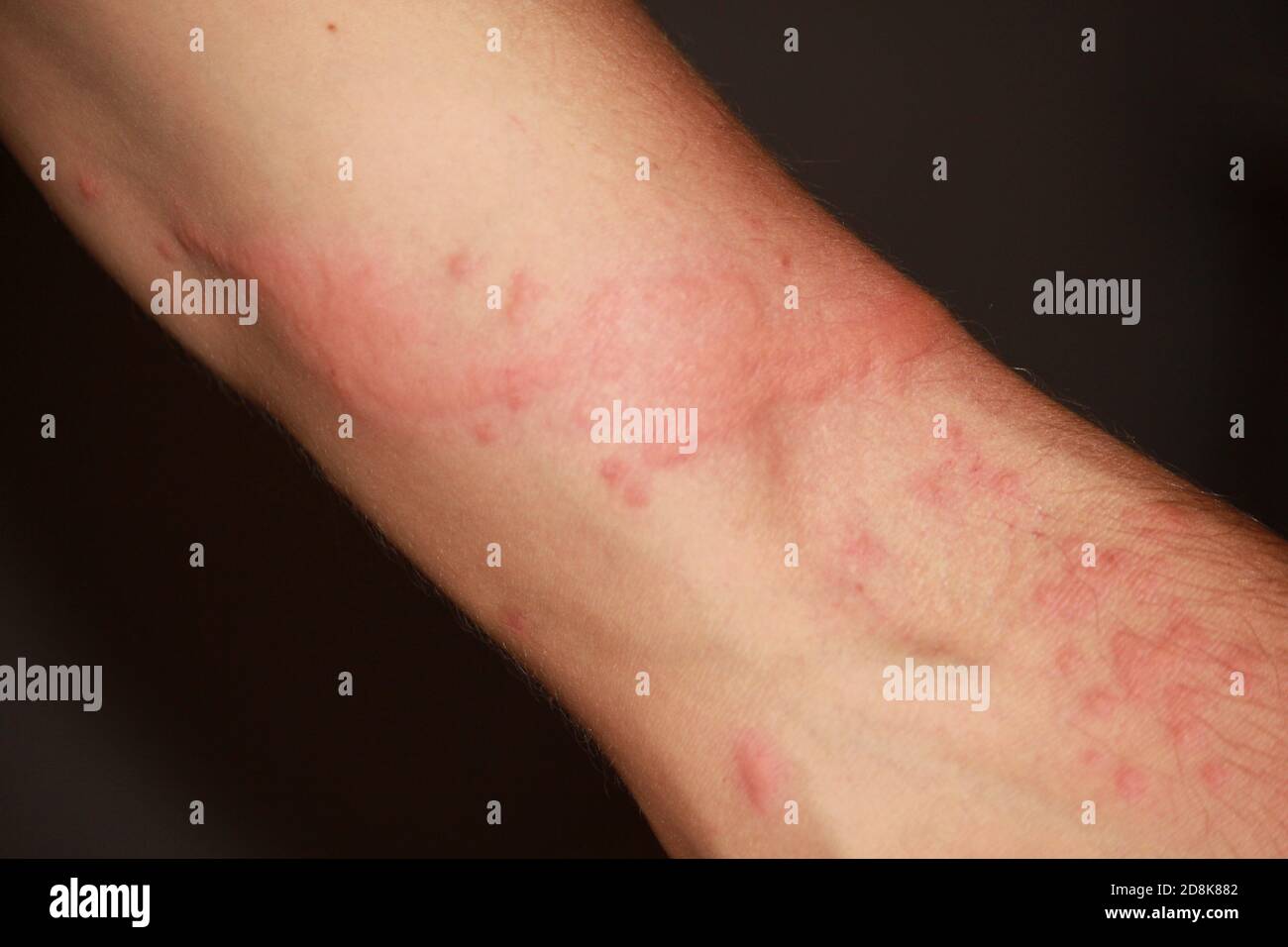 Bite scar on arm hi-res stock photography and images - Alamy