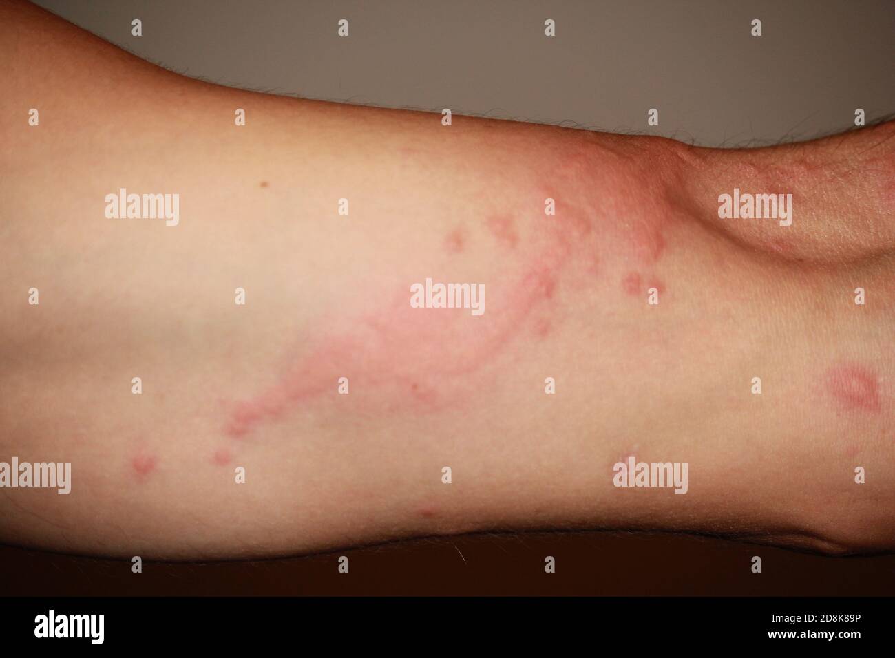 Jelly fish bites on body Stock Photo - Alamy