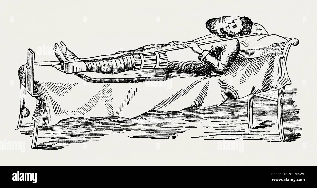 An old engraving of a man being treated for a broken leg (femur) in the 1800s. It is from a Victorian mechanical engineering book of the 1880s. The illustration shows the man lying on a bed. His leg is bandaged and a splint surrounds the upper leg. A weight and pulley system at the base of the bed (counter-extension apparatus) is attached to the foot, helping to extend the limb – allowing the bones fuse without shortening the leg. Wrapping the bone in plaster began in the 1700s. Limbs were often put in traction, pulling the bone back into place, before being set. Stock Photo