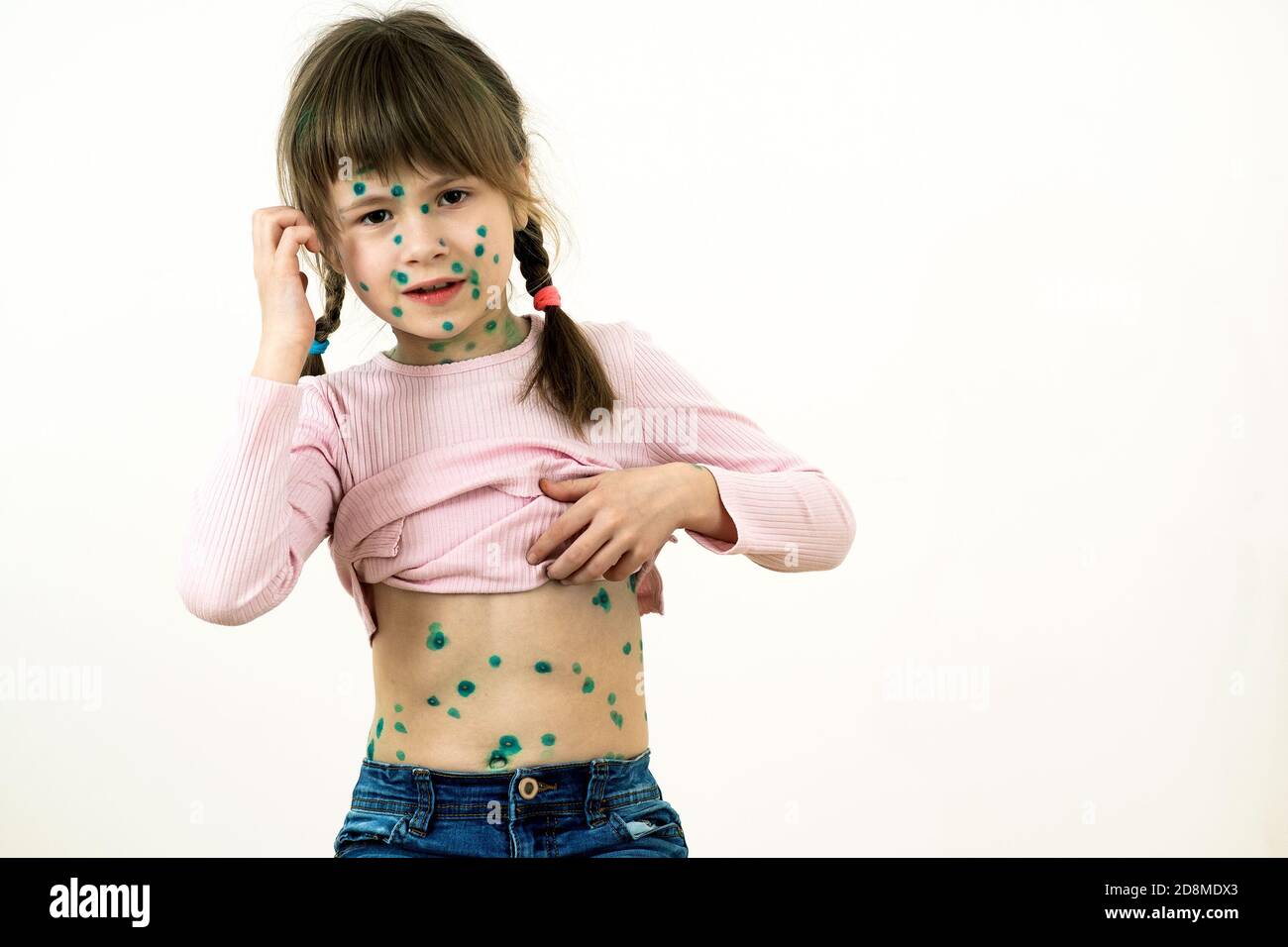 Child girl covered with green rashes on face and stomach ill with chickenpox, measles or rubella virus. Stock Photo