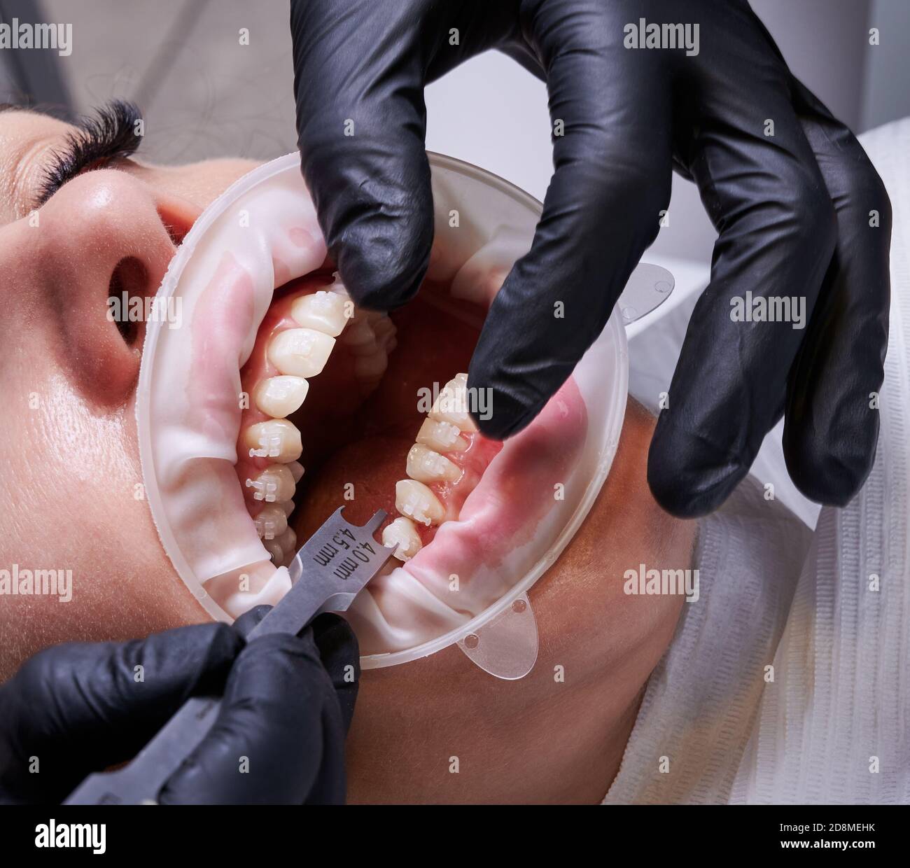 Close up of doctor in black gloves using aluminum bracket gauge while  attaching braces to patient teeth. Woman with cheek retractor and  orthodontic brackets on teeth having dental procedure in clinic Stock