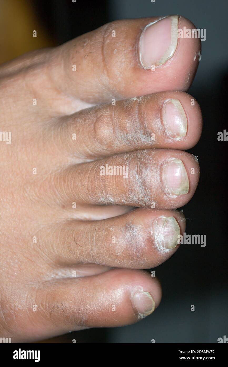 pic What Does Athlete's Foot Look Like Pictures https www alamy com fungal infections may also affect the skin of the feet this is also known as athletes foot image384004378 html