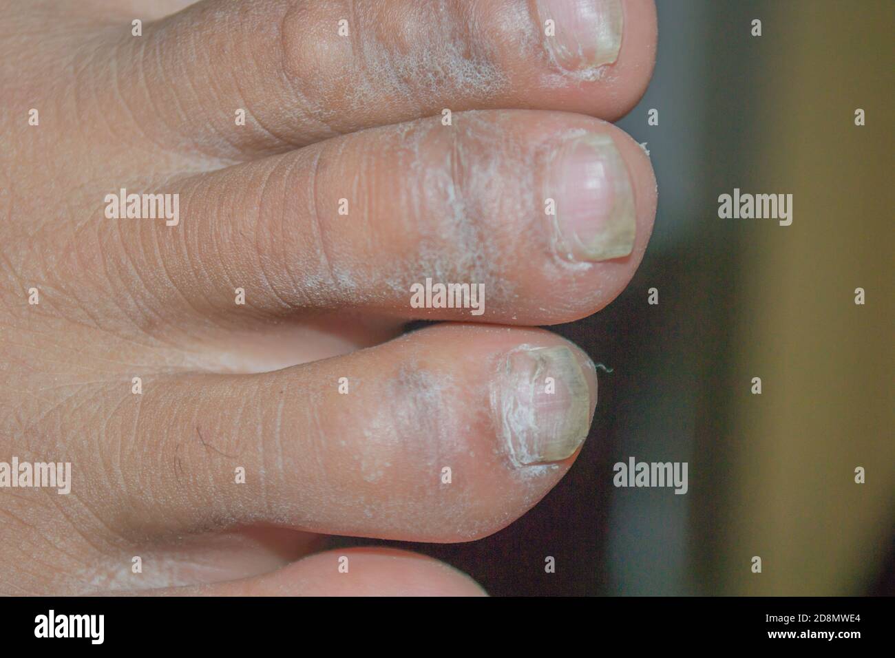 Dry skin on feet fingers outlet