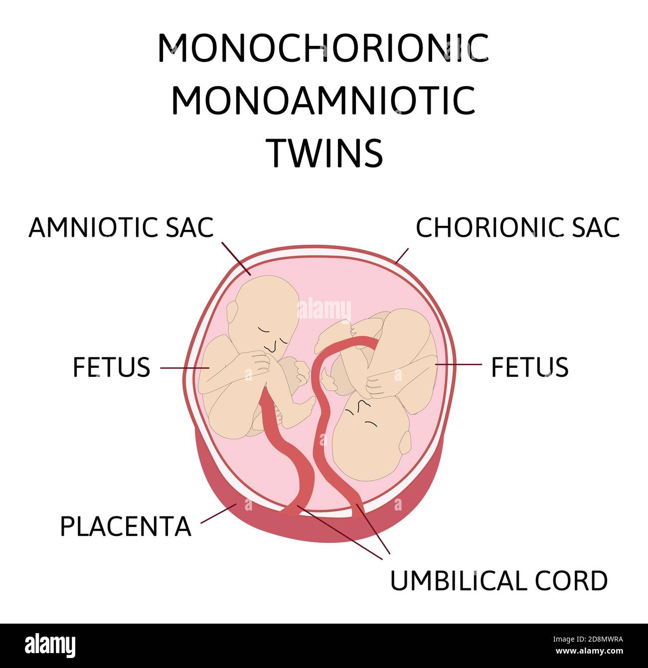 Anatomy of abdomen with twins. Twin types infographic elements in flat ...