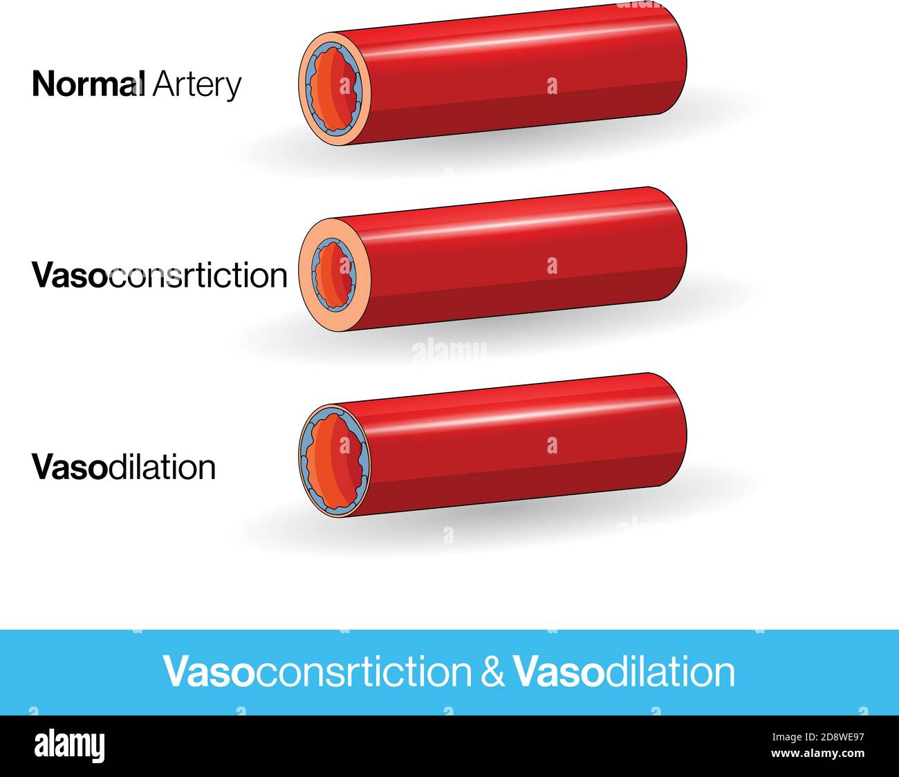 Blood vessels or capillaries or artery showing vasoconstriction and vasodilation blocking the blood flow cross-section and side Stock Vector