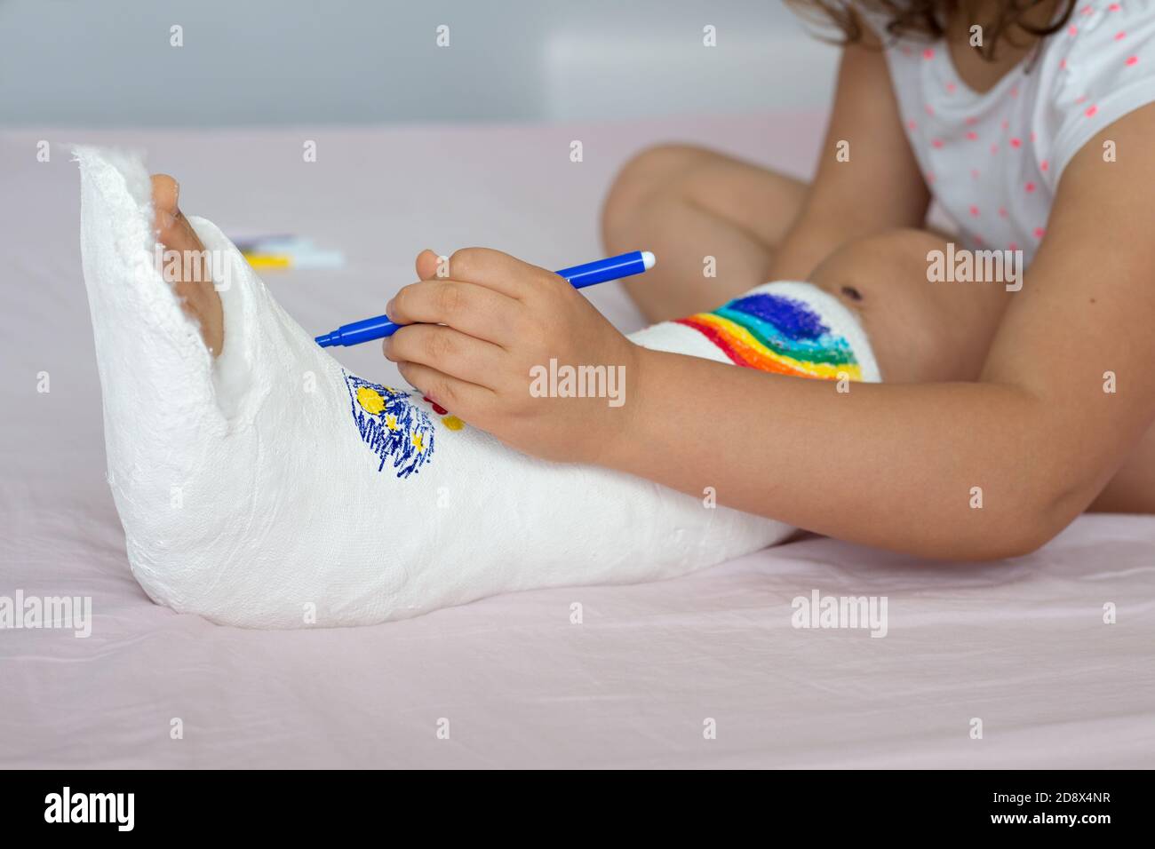 Teenage girl draws on a leg in a cast. A way to have fun with a broken