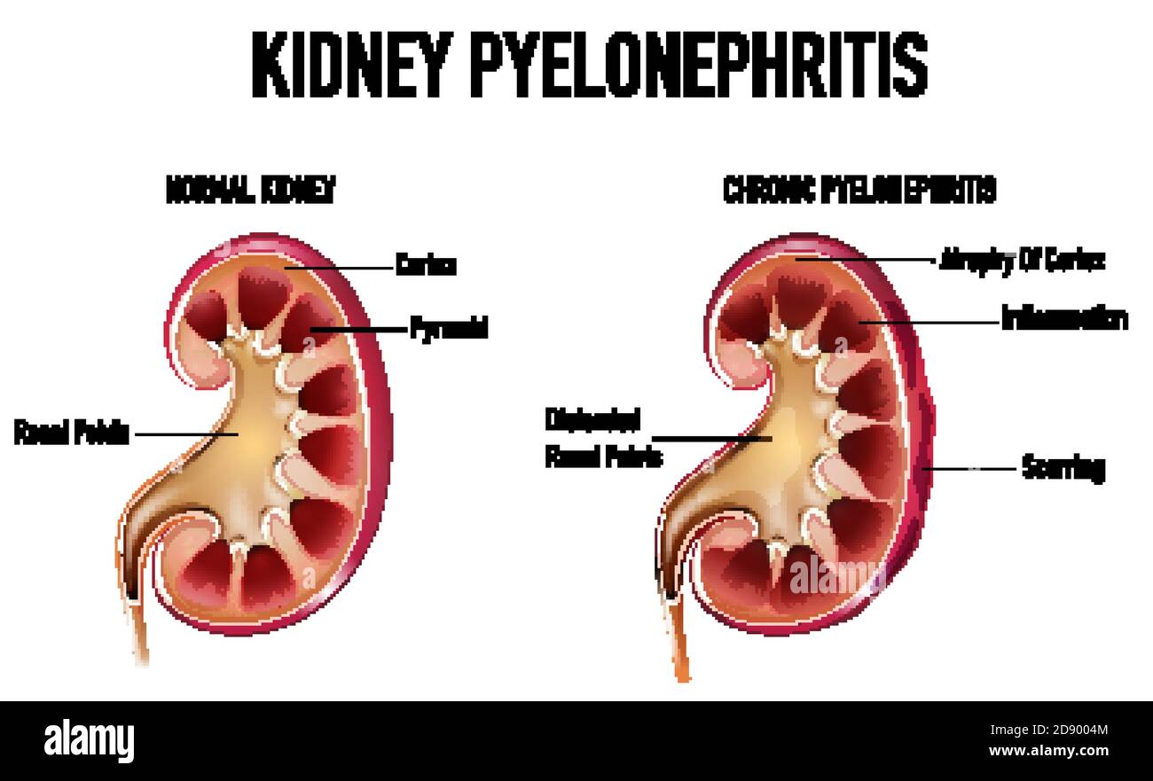 Informative illustration of Pyelonephritis illustration Stock Vector