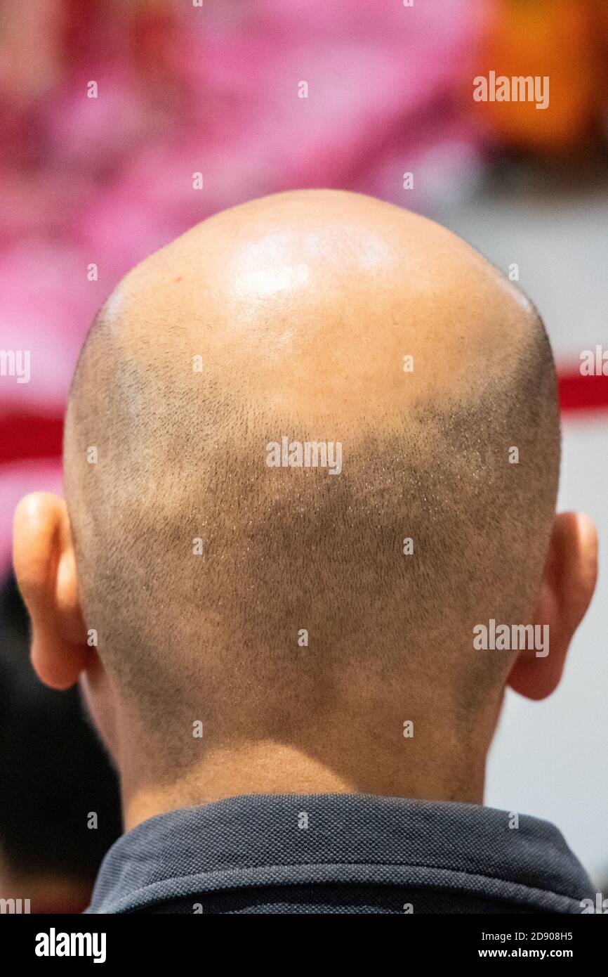 Close-up of man with shaved scalp suffer balding alopecia Stock Photo ...