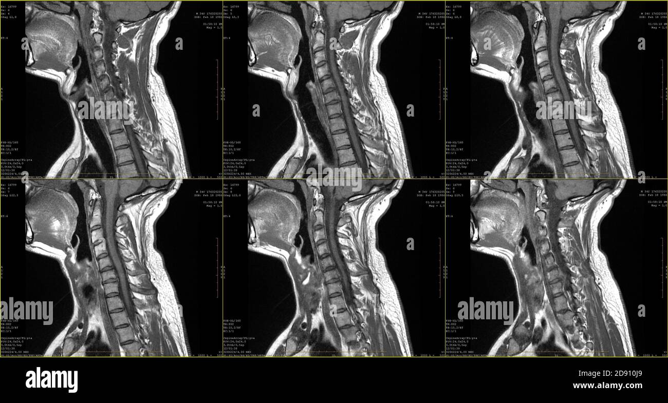 set of 6 sagittal MRI scans of neck area of caucasian 34 years old male with bilateral paramedial extrusion of the C6-C7 segment with radiculopathy Stock Photo