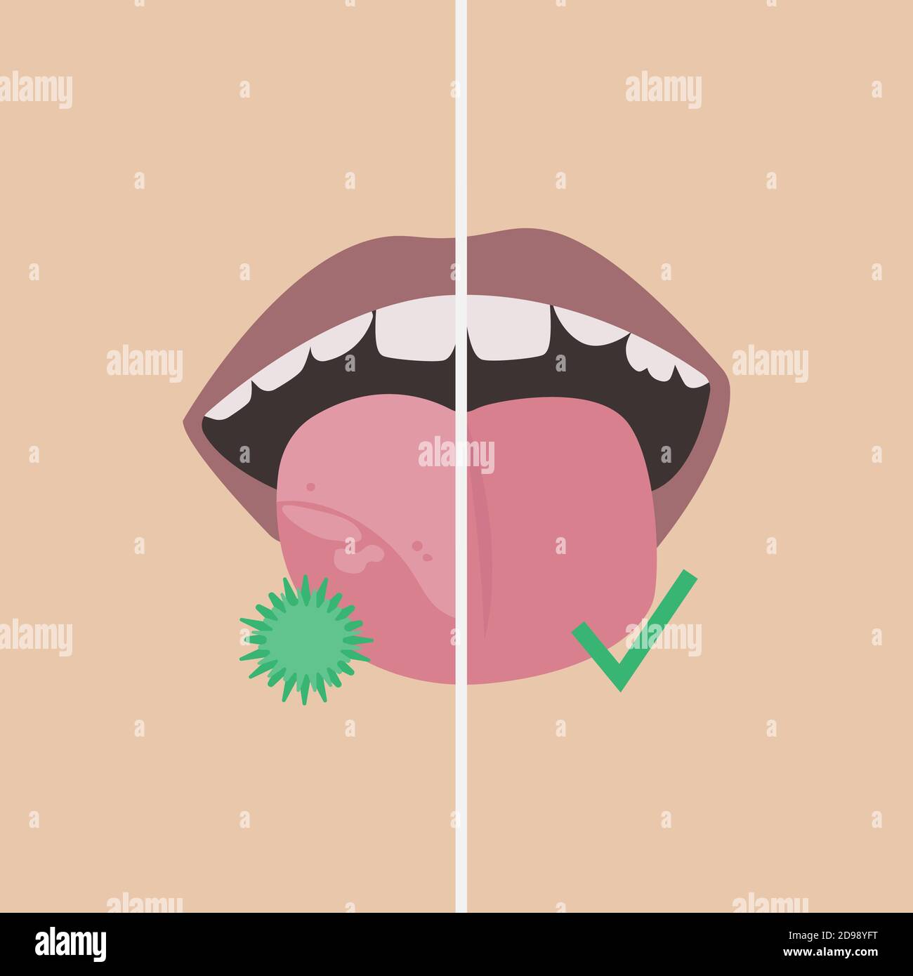 Comparison. White spots on the tongue with bacteria and a healthy tongue. Stock Vector