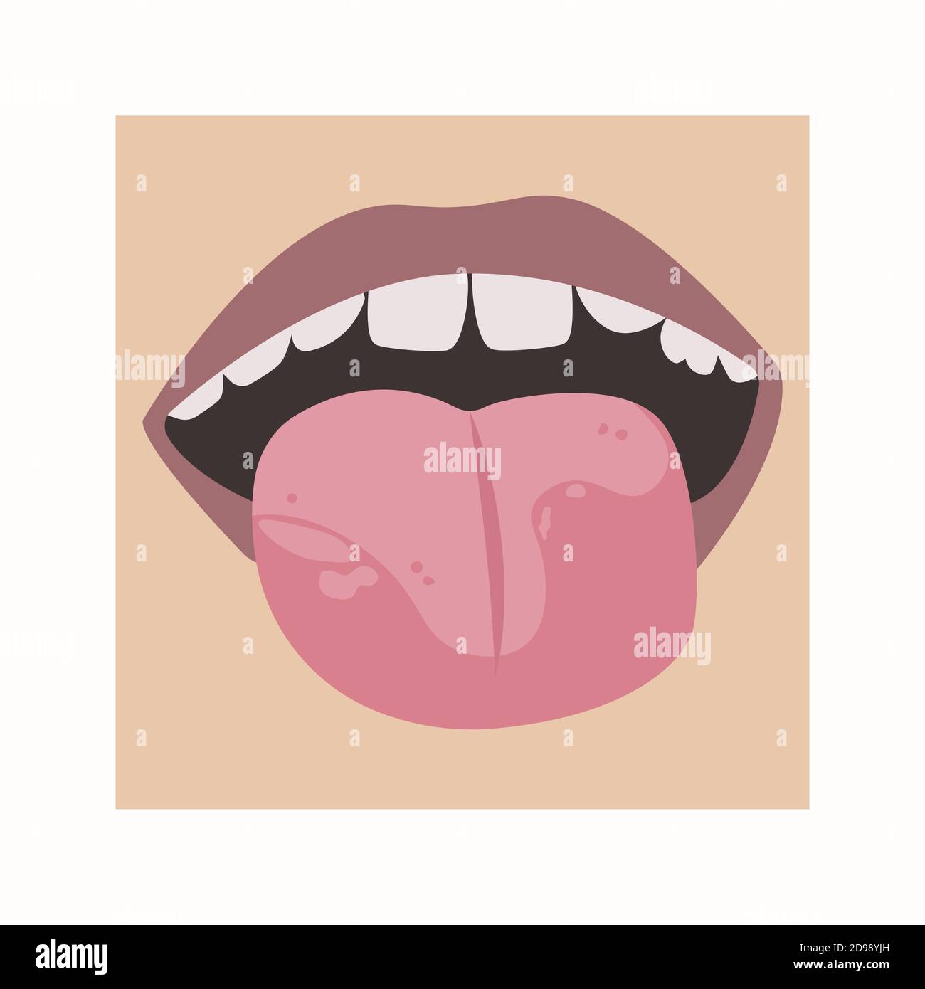 White spots on the tongue. Vector illustration of a child's mouth Stock Vector