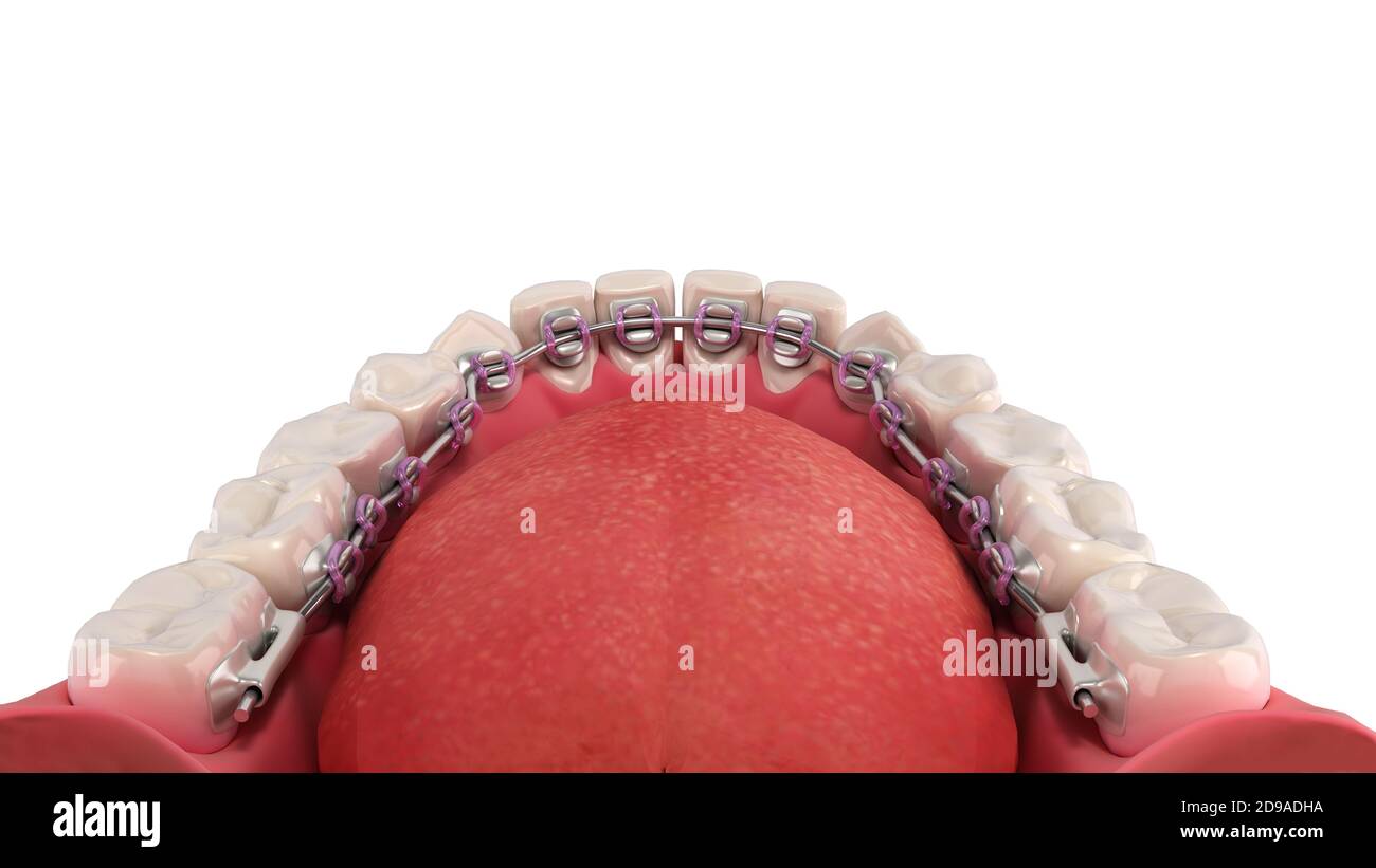 Lingual braces system on a demonstration denture 3d on white Stock