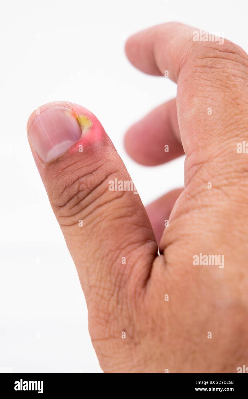 Series of painful finger nail skin infection with pus reatment Stock Photo