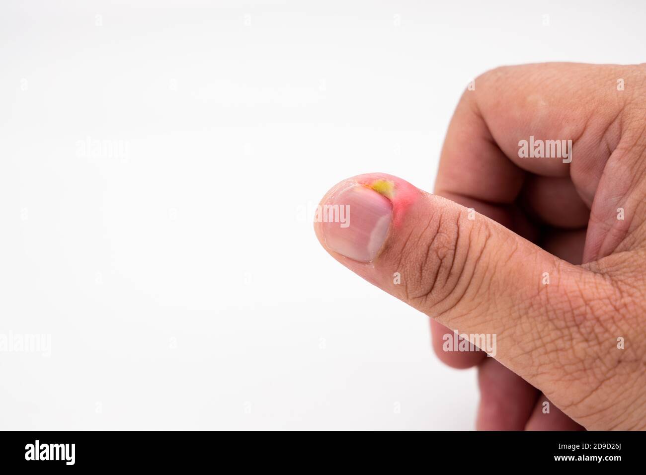 Series of painful finger nail skin infection with pus reatment Stock Photo  - Alamy