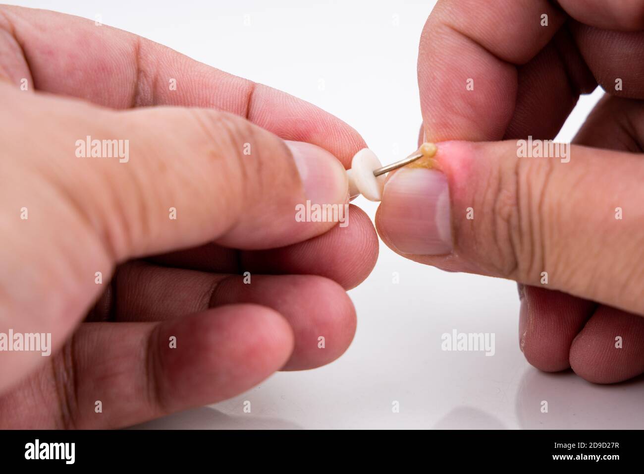 Series of painful finger nail skin infection with pus reatment Stock Photo
