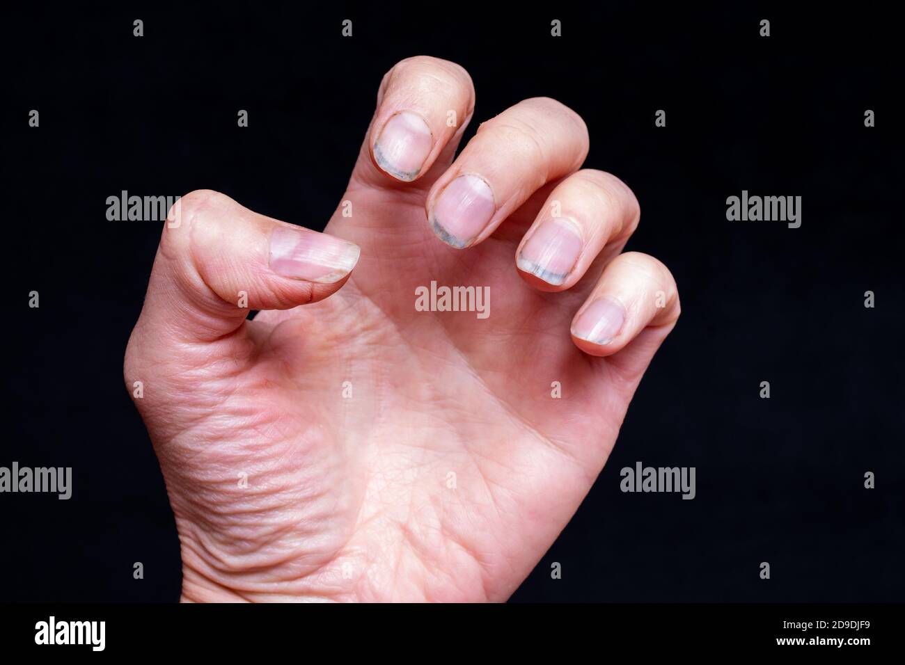 Closeup of female caucasian hand with dirty brittle nails, broken