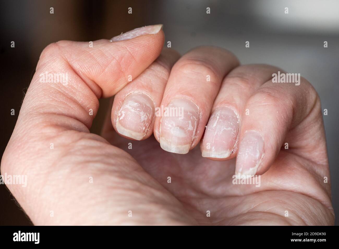 Close-up of brittle nails. Damage to the nail after using shellac or ...