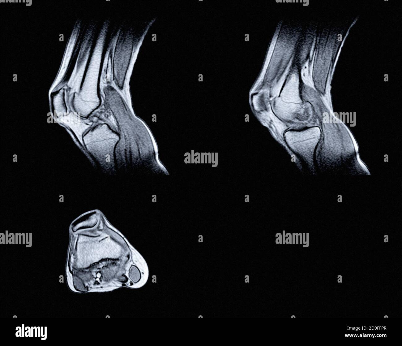 Magnetic resonance imaging (MRI) of right knee. Closed injury of the knee joint, with manifestations of arthrosis. Stock Photo