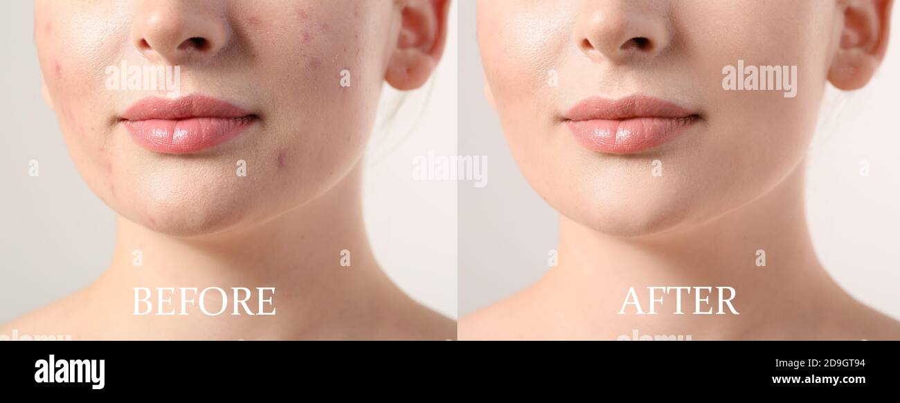 Young woman before and after acne treatment on light background ...