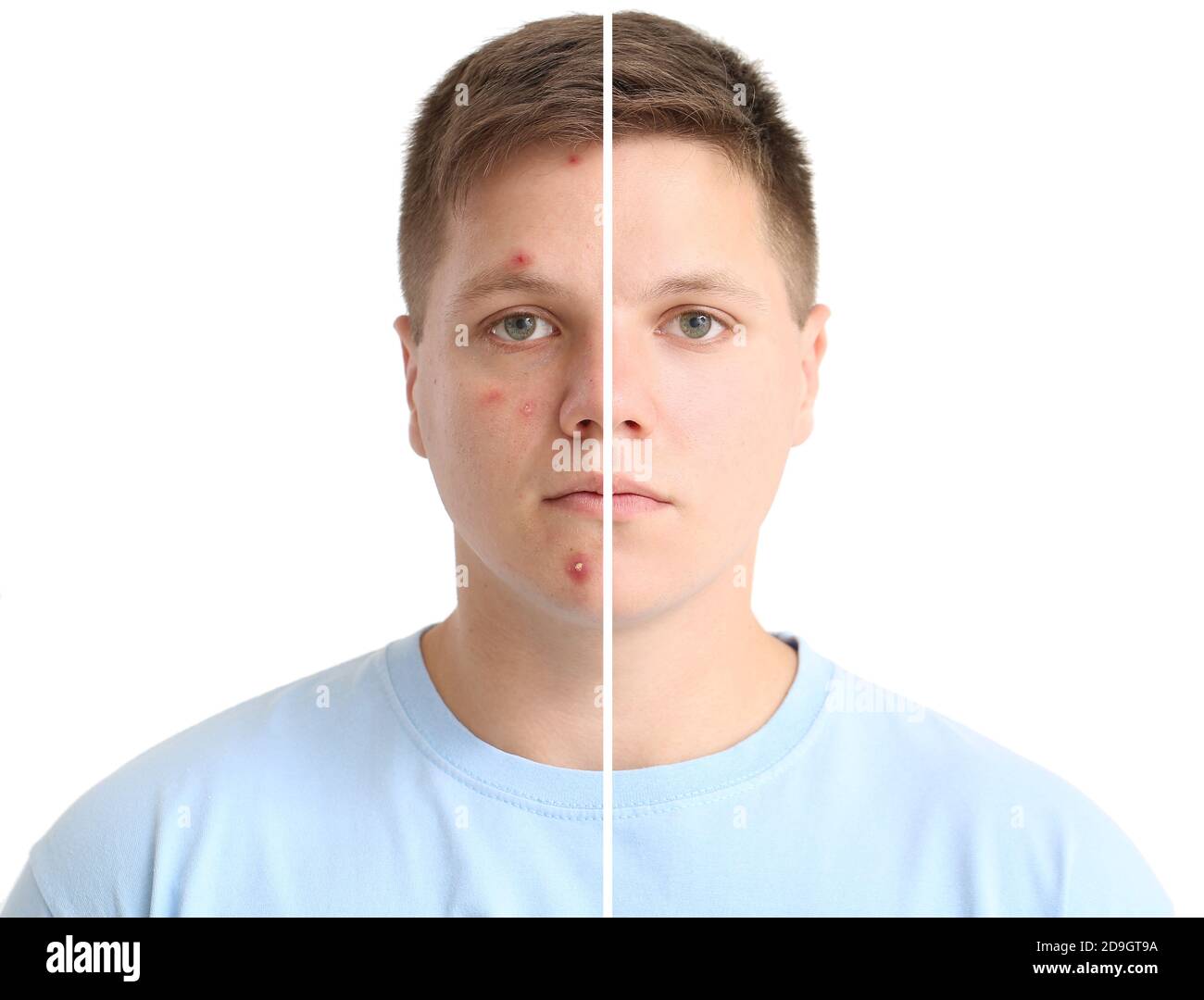 Teenage boy before and after acne treatment on light background Stock ...