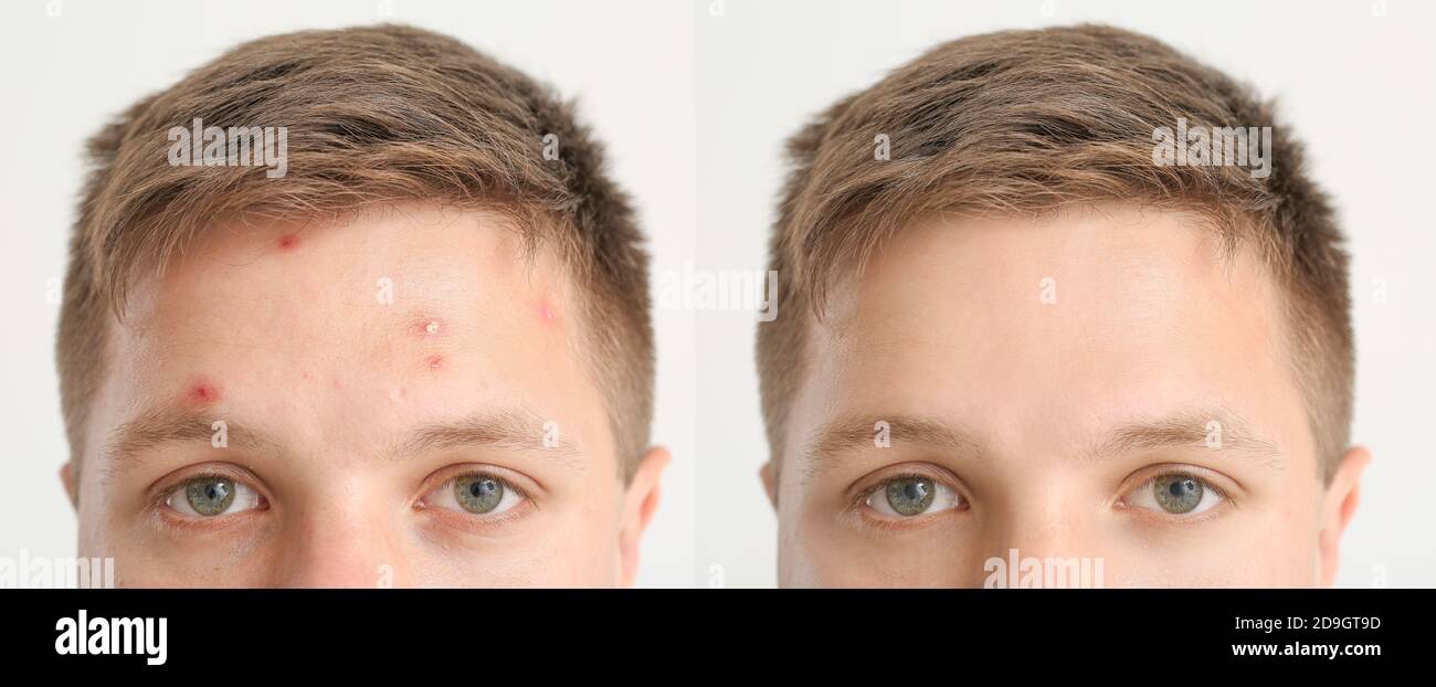 Teenage boy before and after acne treatment on light background ...
