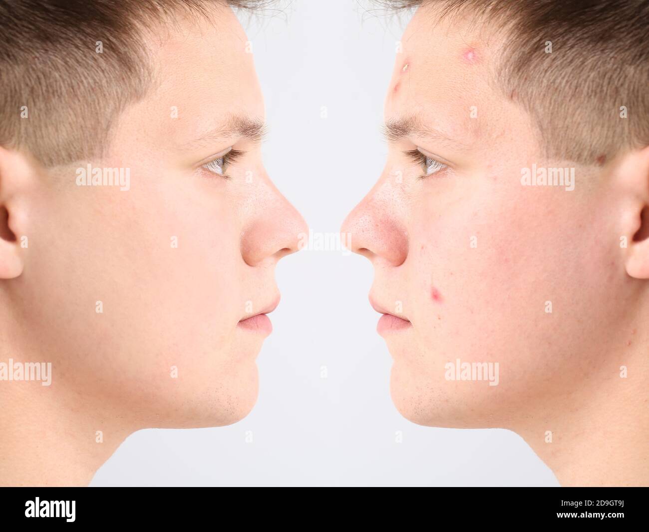 Teenage boy before and after acne treatment on light background Stock ...