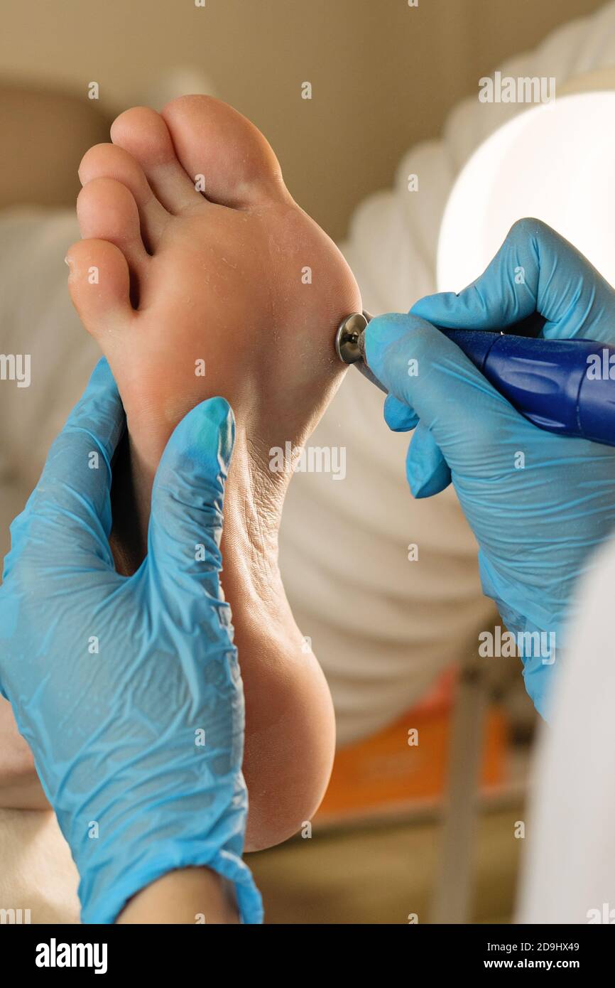 https://c8.alamy.com/comp/2D9HX49/podiatrist-using-grinding-equipment-and-making-procedure-polish-for-feet-hardware-pedicure-callus-peeling-using-professional-pedicure-drill-machine-spa-foot-treatment-removing-hard-callused-skin-2D9HX49.jpg