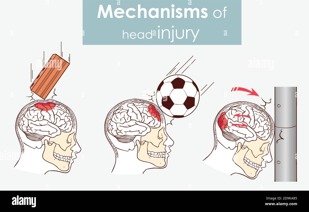 Mechanism Of Brain Injury