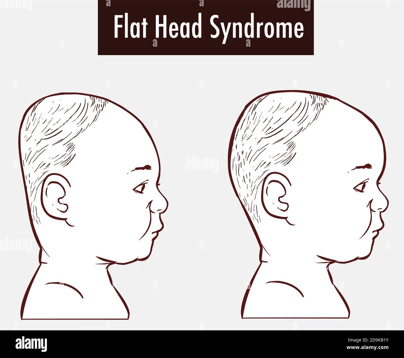 Flat Head Syndrome  Brain  vector illustration Stock Vector