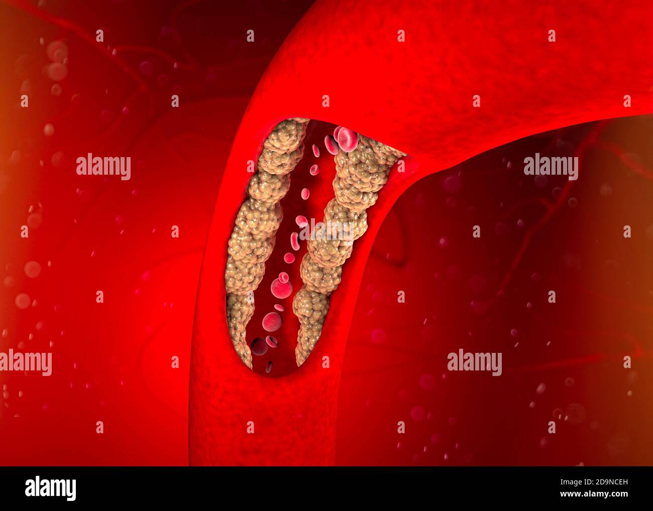 Cholesterol formation, fat, artery, vein, heart. Red blood cells, blood ...