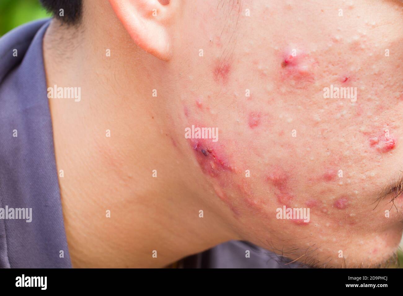 closeup horizontal photo of male cheek with big pimple or acne abcess. Stock Photo