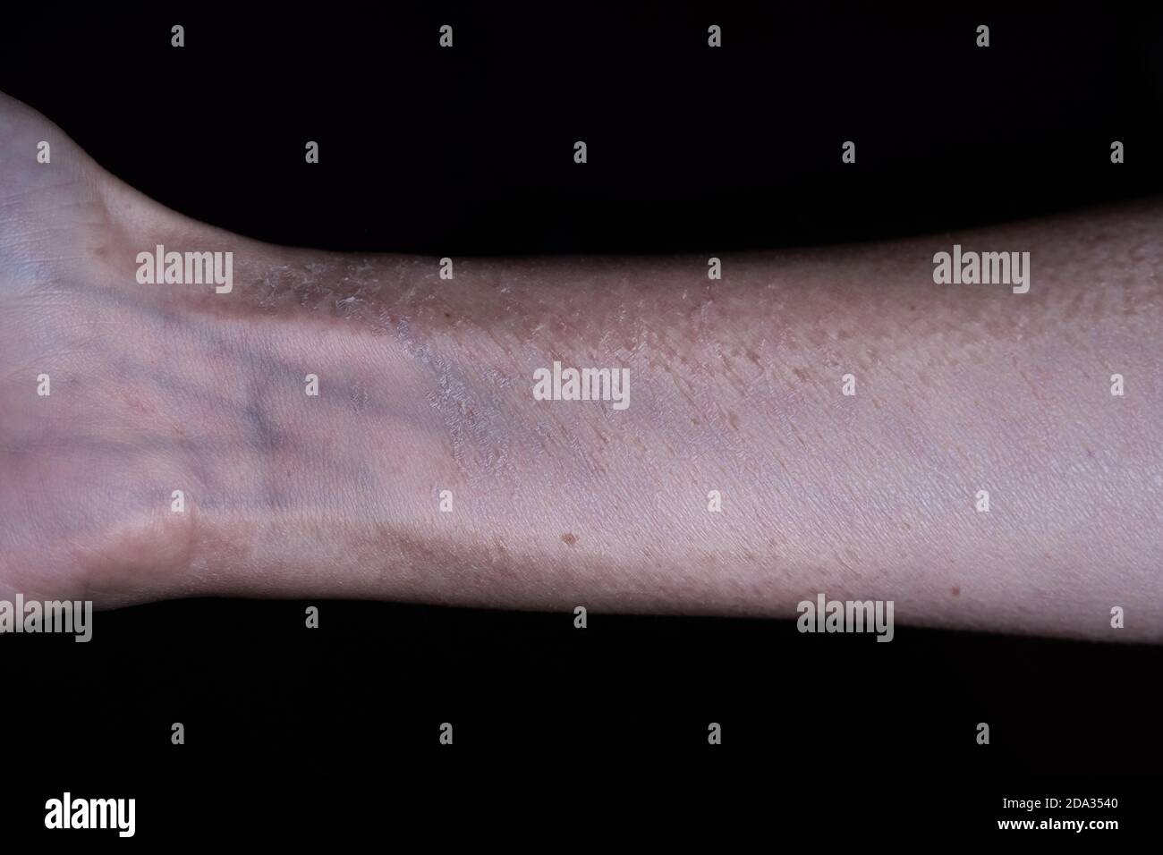 Cropped view of a female arm with dead, exfoliated skin isolated on