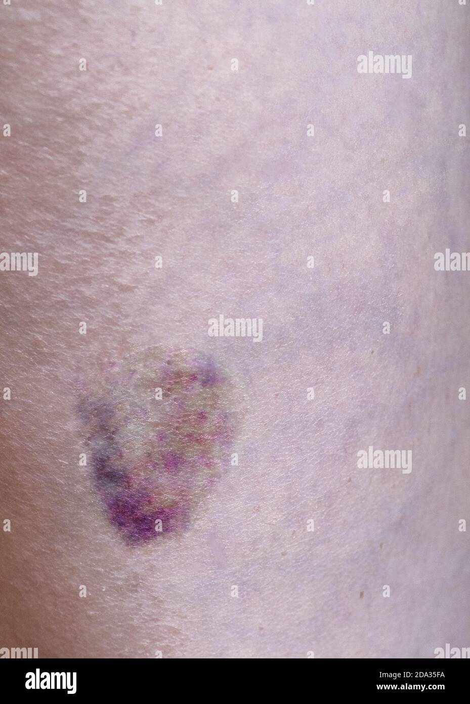 Skin abrasion hires stock photography and images Alamy