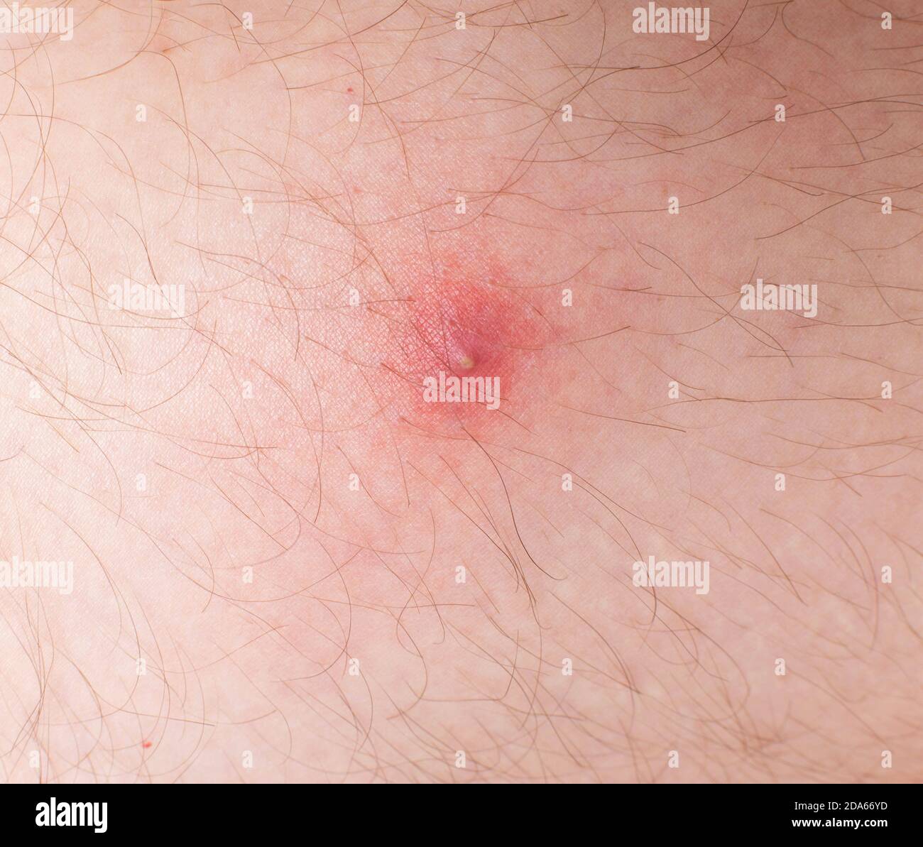 Red pimple on problem skin, close-up, hormone Stock Photo - Alamy