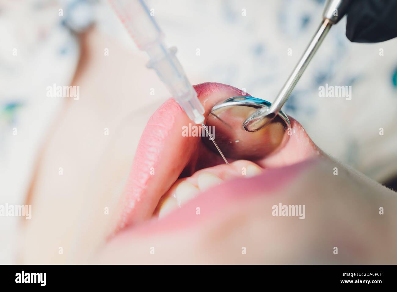 Dentist giving injection for anesthetizing his patient Stock Photo Alamy