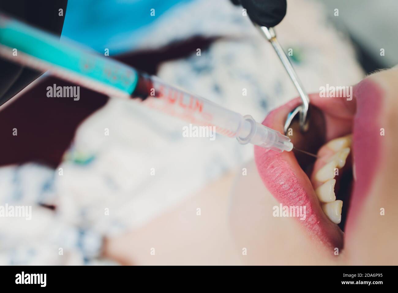 Dentist giving injection for anesthetizing his patient Stock Photo - Alamy