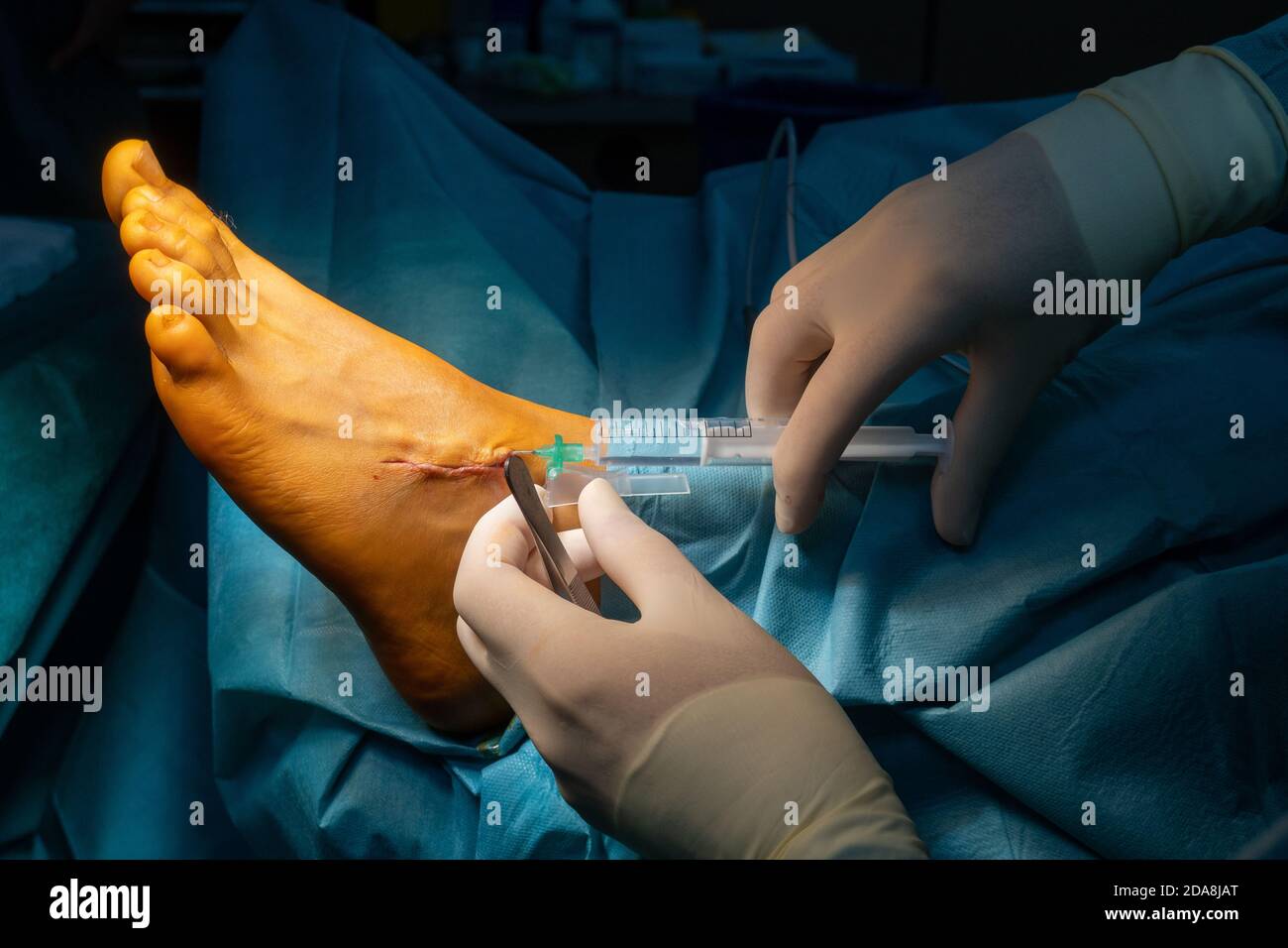 a surgeon anesthetizes a wound with local anesthetic in a syringe Stock