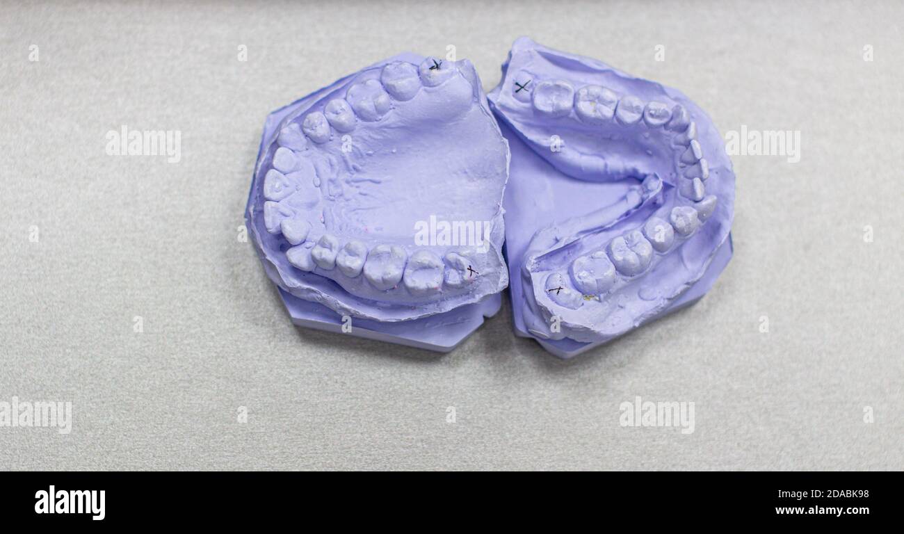 Plaster cast of teeth from plaster at the orthodontist Stock Photo Alamy