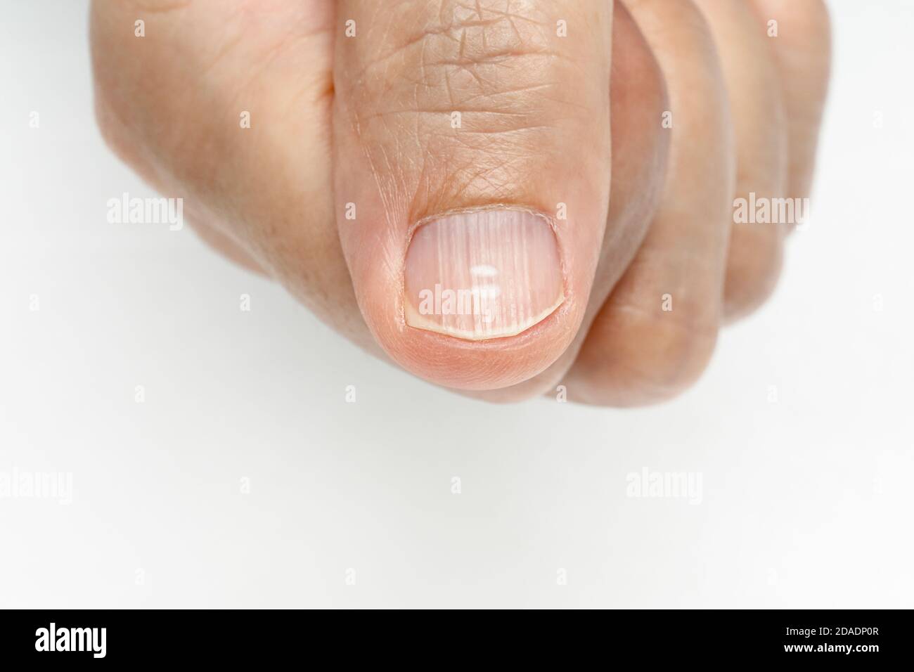 Spotted white fingernails | MDedge Family Medicine
