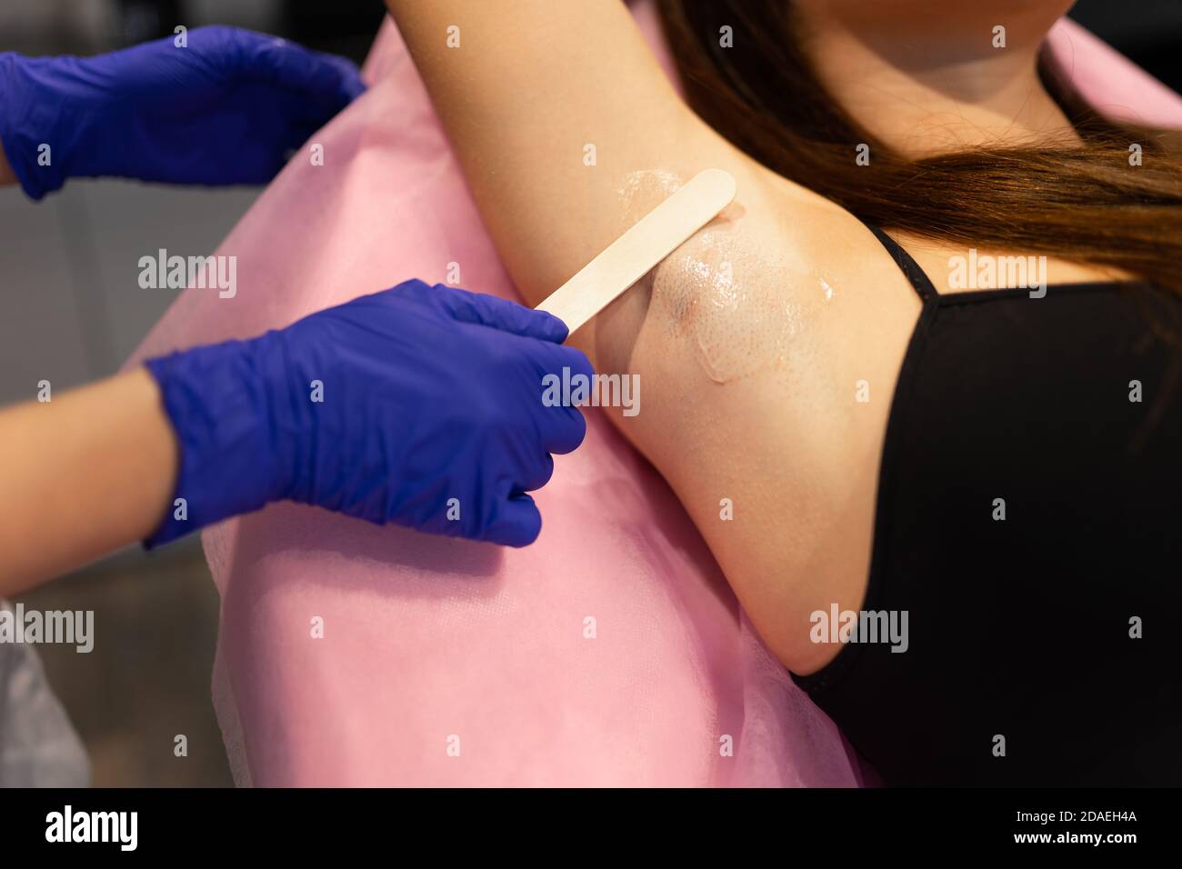 Applying laser hair removal gel to the patient's armpits Stock Photo - Alamy Applying laser hair removal gel to the patient's armpits Stock Photo - Alamy