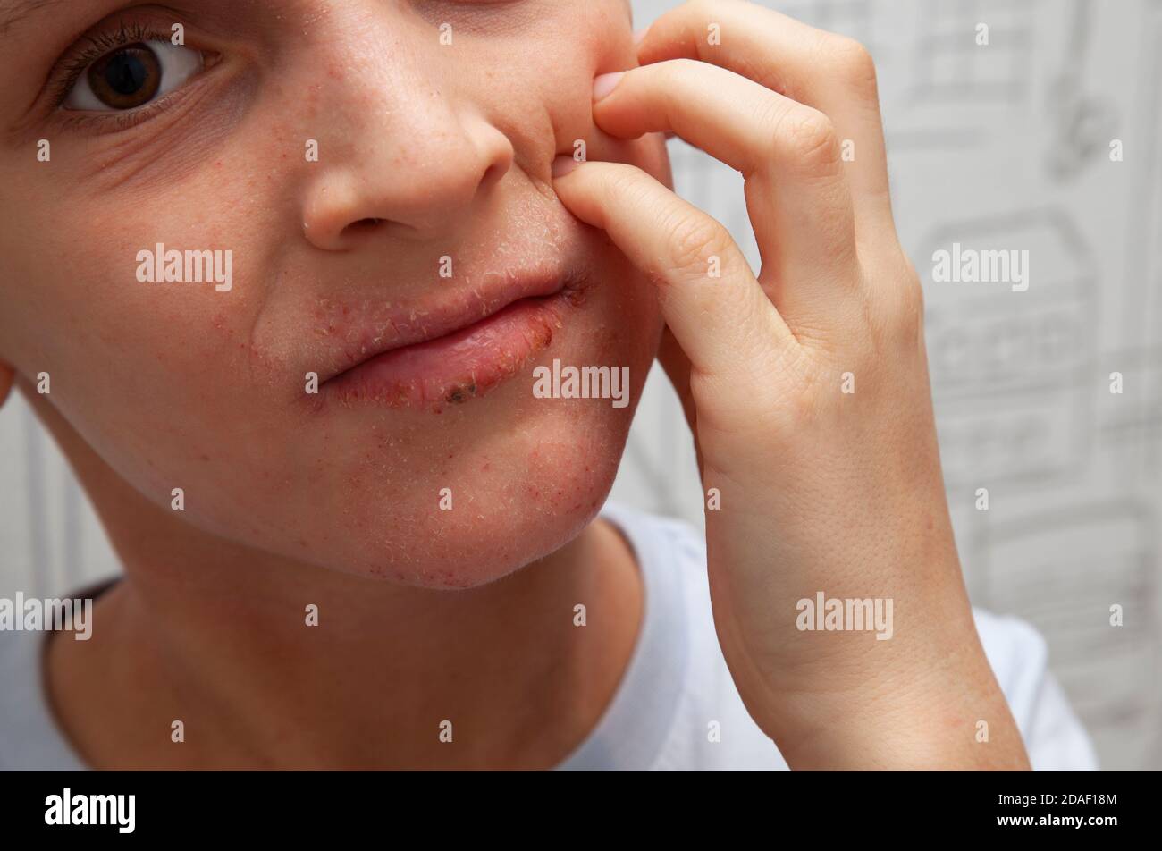 Atopic skin on the boy face. Human skin, presenting an allergic reaction, allergic rash on face and lips. Health care and medicine concept. Stock Photo