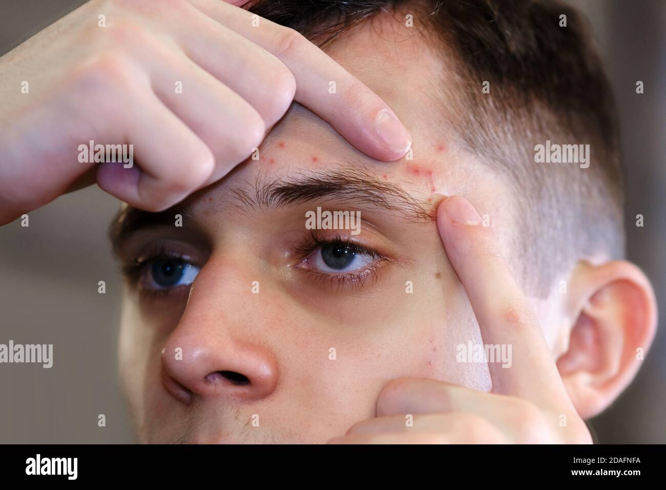 A teenager cleans his face from acne. Profile of a teenager looking at his face in the mirror. Problems with the skin Stock Photo