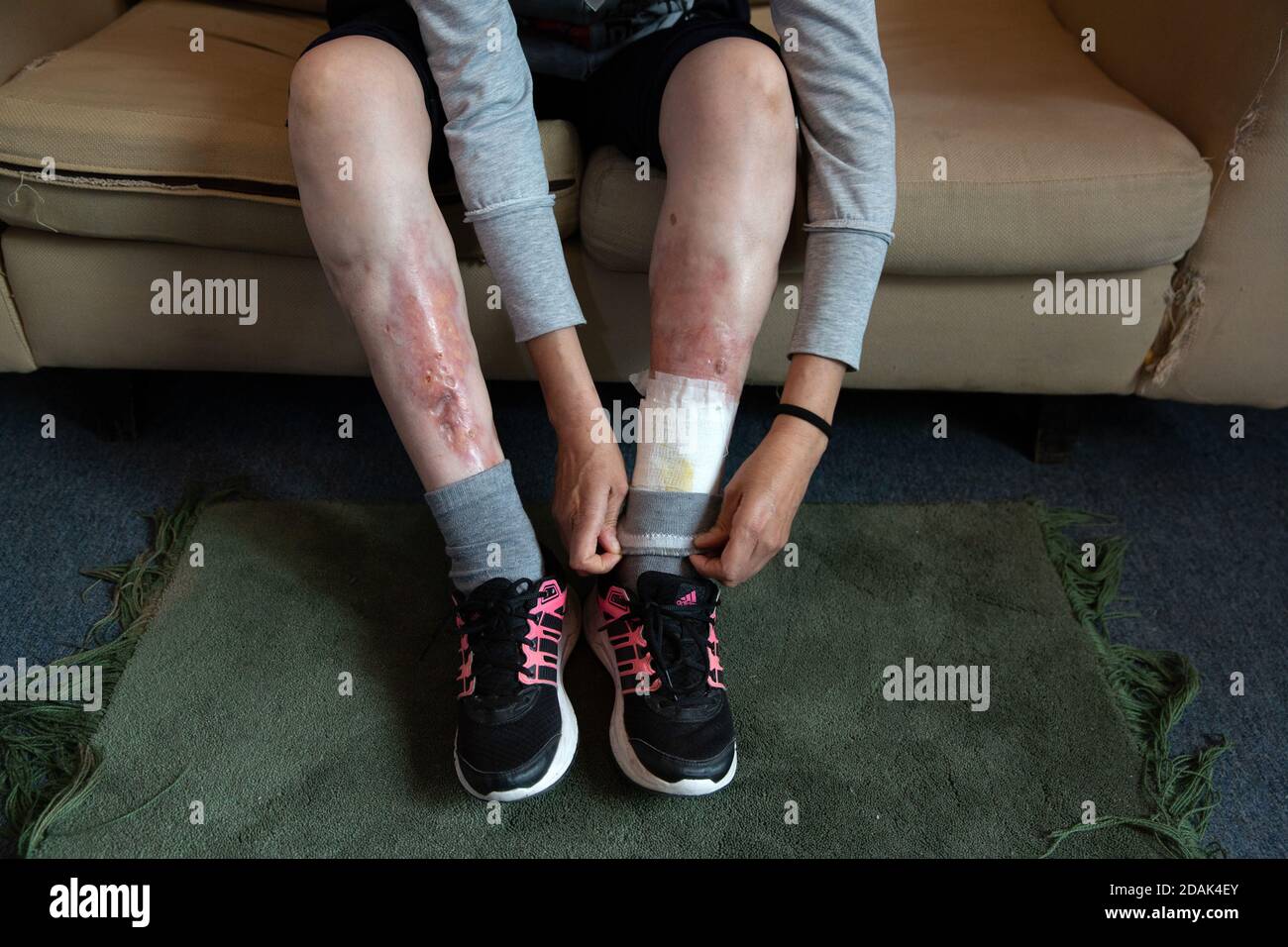 Zucey shows the ulcers on her legs while sitting in her home in Mexico City, Mexico, on March 8, 2019. Zucey Gil is a 50-year-old woman living in Mexico City with her two children and is being treated for human adjuvant disease. Zucey was 22 years old when she received her first mineral oil injections for cosmetic purposes from the owner (also a dermatologist) of the beauty clinic she worked for and whom offered to inject all of her employees for free. At the time injectables were all the rage, the majority of patients were seeking injections. Most of them are dead now states Zucey. Obsession Stock Photo