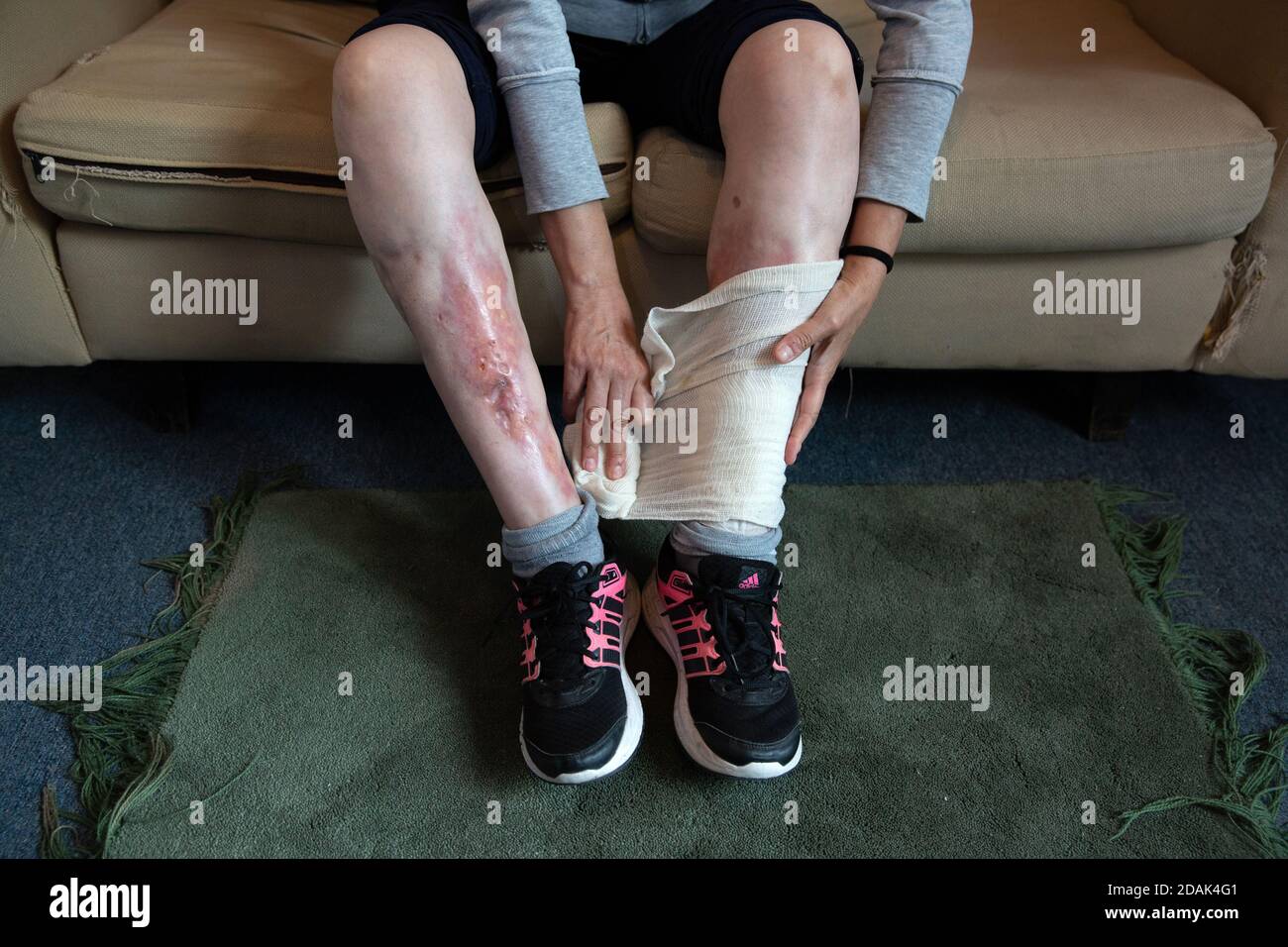 Zucey shows the ulcers on her legs while sitting in her home in Mexico City, Mexico, on March 8, 2019. Zucey Gil is a 50-year-old woman living in Mexico City with her two children and is being treated for human adjuvant disease. Zucey was 22 years old when she received her first mineral oil injections for cosmetic purposes from the owner (also a dermatologist) of the beauty clinic she worked for and whom offered to inject all of her employees for free. At the time injectables were all the rage, the majority of patients were seeking injections. Most of them are dead now states Zucey. Obsession Stock Photo