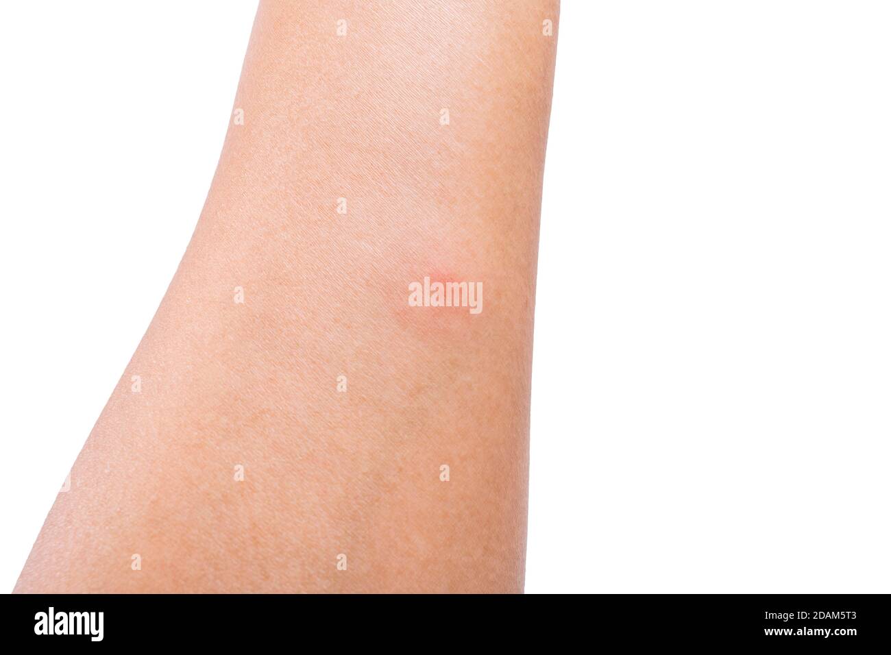 The close up photo of red spot swollen and allergies from insect bites on human arm Stock Photo